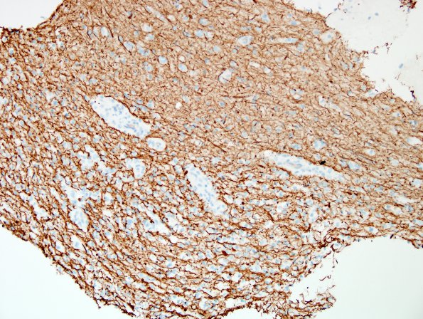 9D1 ADEM, prominent axonal degeneration (fulminant ADEM, Case 9) NF 20X