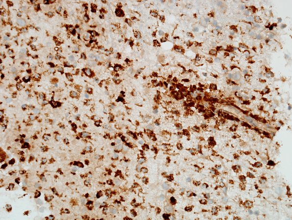 9E1 ADEM, prominent axonal degeneration (fulminant ADEM, Case 9) CD68 40X 1