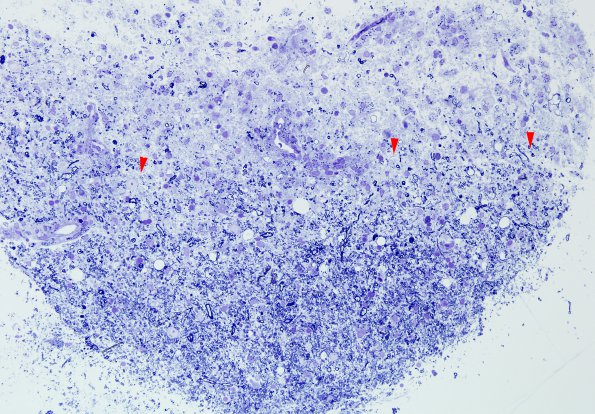 9F1 ADEM, axonopathic (fulminant ADEM, Case 9) Plastic 2 copy.