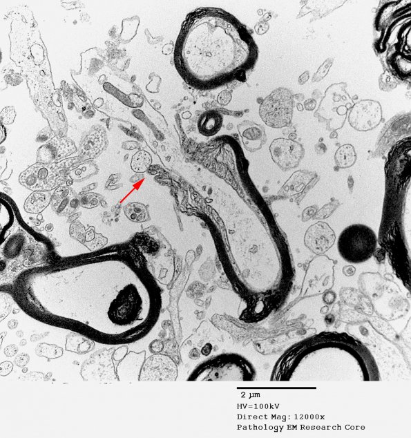 9G1 ADEM, axonopathic (fulminant ADEM, Case 9) EM 73 copy - Copy