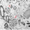 9G2 ADEM, axonopathic (fulminant ADEM, Case 9) EM 83 copy - Copy