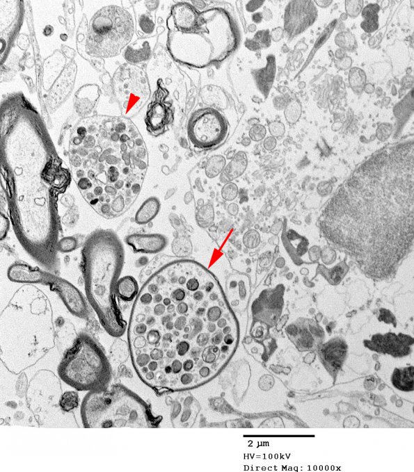 9G2 ADEM, axonopathic (fulminant ADEM, Case 9) EM 83 copy - Copy