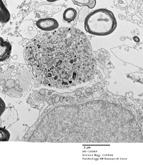 9G3 ADEM, axonopathic (fulminant ADEM, Case 9) EM 53 - Copy