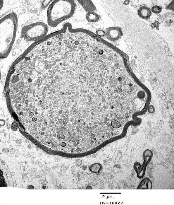 9G5 ADEM, axonopathic (fulminant ADEM, Case 9) EM 59 - Copy