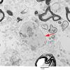 9G4 ADEM, axonopathic (fulminant ADEM, Case 9) EM 6 copy - Copy