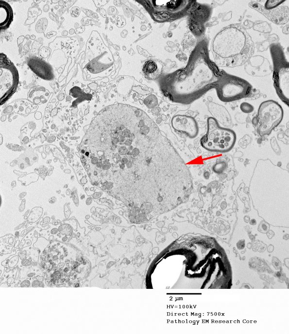 9G4 ADEM, axonopathic (fulminant ADEM, Case 9) EM 6 copy - Copy