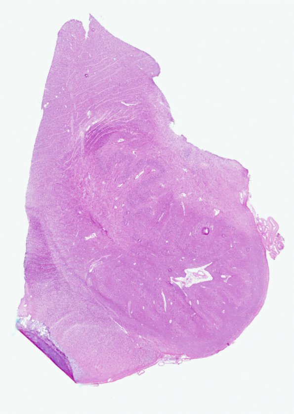 12B1 Multiple Sclerosis (Case 12) Medulla H&E whole mount