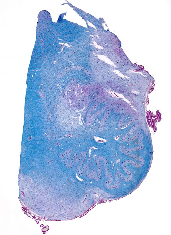 12B2 Multiple Sclerosis (Case 12) Medulla LFB-PAS whole mount