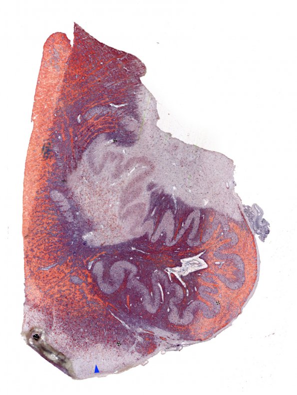 12B3 Multiple Sclerosis (Case 12) Medulla ORO whole mount copy