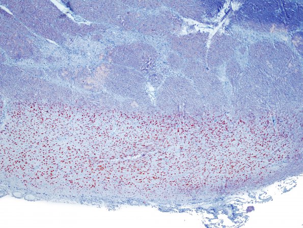 12B4 Multiple Sclerosis (Case 12) ORO 5