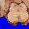 13A2 Multiple Sclerosis (Case 13) 1A