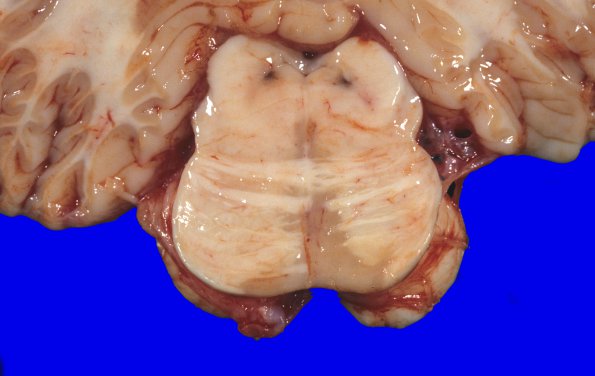 13A2 Multiple Sclerosis (Case 13) 1A