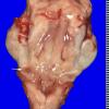 14A1 Multiple Sclerosis, 50 yr Hx (Case 14) 18 copyA