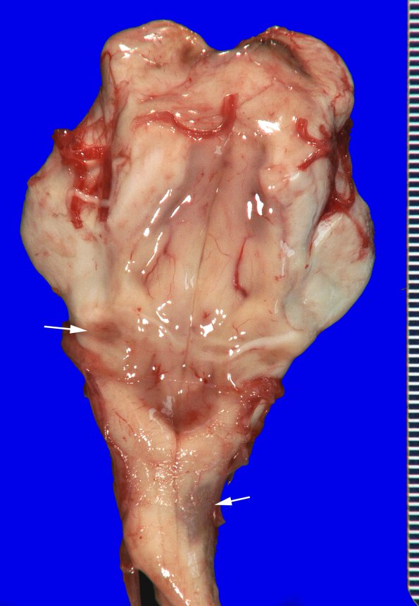 14A1 Multiple Sclerosis, 50 yr Hx (Case 14) 18 copyA