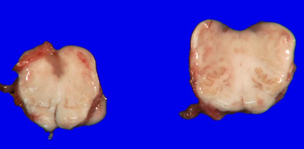 14A2 Multiple Sclerosis, 50 yr Hx (Case 14) 19A