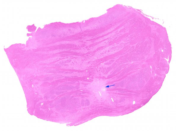 14B1 Multiple Sclerosis, 50 yr Hx (Case 14) N16 sequential sections Pons H&E WM copy