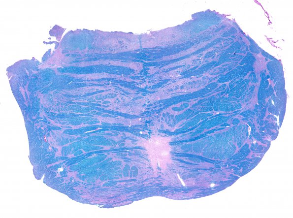 14B2 Multiple Sclerosis, 50 yr Hx (Case 14) N16 sequential sections Pons LFB-PAS whole mount