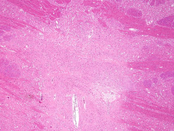 14C1 Multiple Sclerosis, 50 yr Hx (Case 14) N16 sequential sections Pons H&E 4X