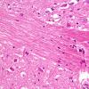 14C10 Multiple Sclerosis, 50 yr Hx (Case 14) N16 sequential sections Pons H&E 40X