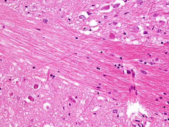 14C10 Multiple Sclerosis, 50 yr Hx (Case 14) N16 sequential sections Pons H&E 40X