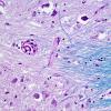 14C11 Multiple Sclerosis, 50 yr Hx (Case 14) N16 sequential sections Pons LFB-PAS 40X