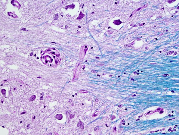 14C11 Multiple Sclerosis, 50 yr Hx (Case 14) N16 sequential sections Pons LFB-PAS 40X