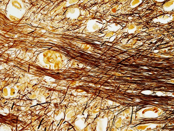 14C12 Multiple Sclerosis, 50 yr Hx (Case 14) N16 sequential sections Pons Biels 40X