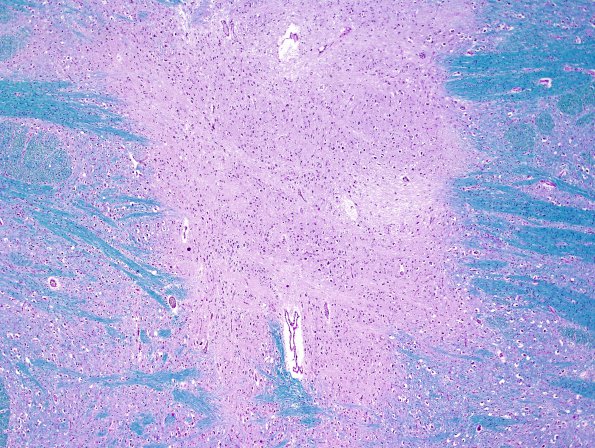 14C2 Multiple Sclerosis, 50 yr Hx (Case 14) N16 sequential sections Pons LFB-PAS 4X