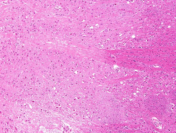 14C4 Multiple Sclerosis, 50 yr Hx (Case 14) N16 sequential sections Pons H&E 10X