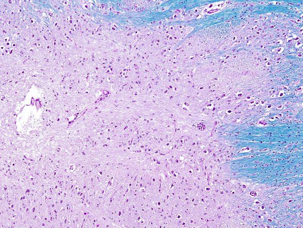 14C5 Multiple Sclerosis, 50 yr Hx (Case 14) N16 sequential sections Pons LFB-PAS 10X