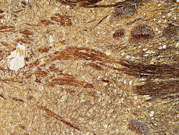 14C6 Multiple Sclerosis, 50 yr Hx (Case 14) N16 sequential sections Pons Biels 10X