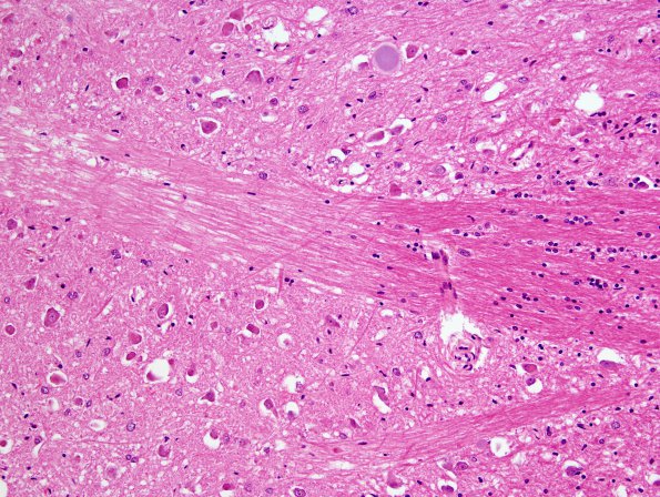 14C7 Multiple Sclerosis, 50 yr Hx (Case 14) N16 sequential sections Pons H&E 20X