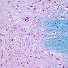 14C8 Multiple Sclerosis, 50 yr Hx (Case 14) N16 sequential sections Pons LFB-PAS 20X