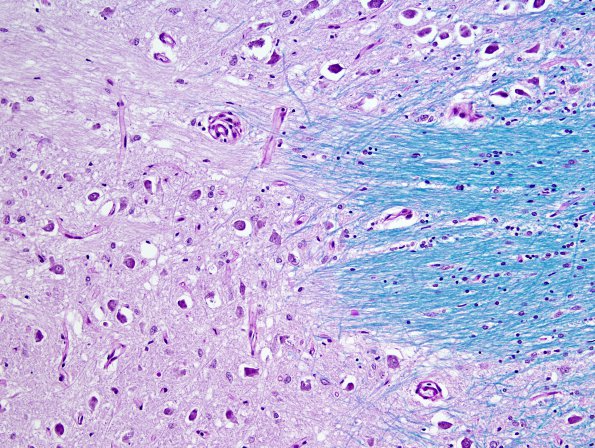 14C8 Multiple Sclerosis, 50 yr Hx (Case 14) N16 sequential sections Pons LFB-PAS 20X