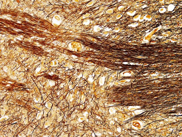 14C9 Multiple Sclerosis, 50 yr Hx (Case 14) N16 sequential sections Pons Biels 20X