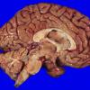 15A3 Multiple Sclerosis (Case 15) sagittal 2A