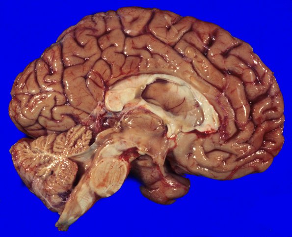 15A3 Multiple Sclerosis (Case 15) sagittal 2A