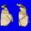 15A5 Multiple Sclerosis (Case 15) 1 (2)A