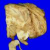 15A6 Multiple Sclerosis (Case 15) 6A