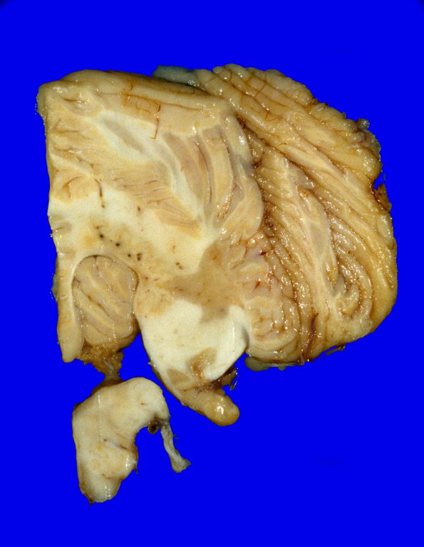 15A6 Multiple Sclerosis (Case 15) 6A