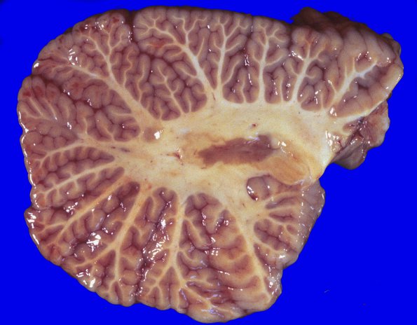 18A1 Multiple Sclerosis (Case 18) 2A