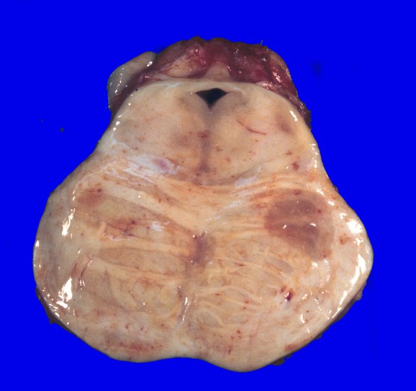 18A2 Multiple Sclerosis (Case 18) 3A