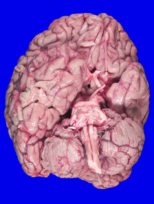 19A1 MS, RRMS (Case 19) _2A