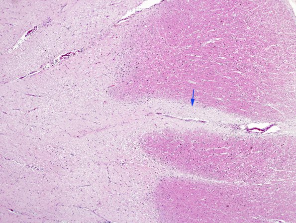 1C1 MS (Case 1) midbrain B5 H&E 10 copy