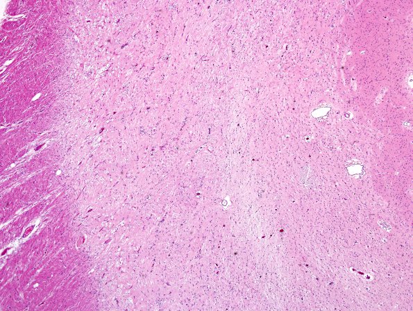 1C2 MS (Case 1) midbrain B5 H&E 1