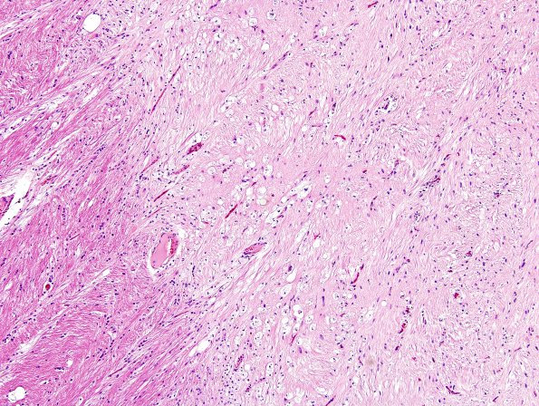 1C3 MS (Case 1) midbrain B5 H&E 2