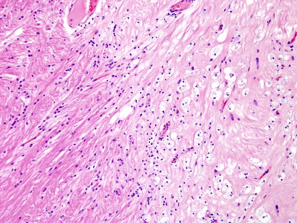 1C4 MS (Case 1) midbrain B5 H&E 3