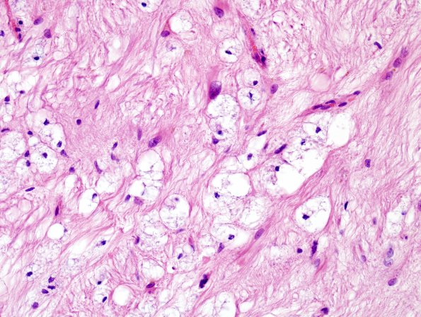 1C5 MS (Case 1) midbrain B5 H&E 4