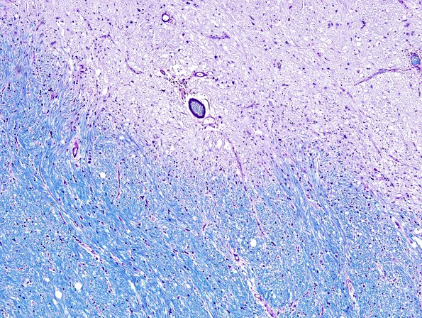 1D1 MS (Case 1) brainstem LFB-PAS 10X