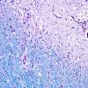 1D3 MS (Case 1) brainstem LFB-PAS 20X